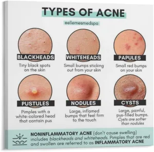 Different Types of Acne Poster (3) Canvas Print Wall Art Decor Living Room Office Bedroom 8x8inch(20x20cm) Frame-style