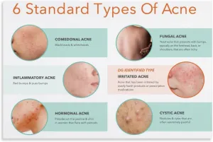 Different Types of Acne Poster (4) Canvas Print Wall Art Decor Living Room Office Bedroom 36x24inch(90x60cm) Unframe-style